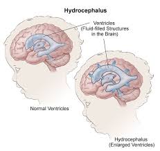 Image result for Hydrocephalus
