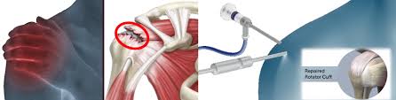 Image result for Rotator Cuff Rupture