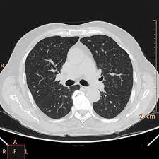 Valuta la capacità di perfusione e ventilazione polmonare. Tc Torace Centro Medico La Quintana