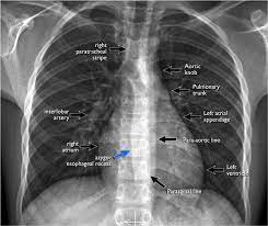 Understand the normal chest x ray. The Radiology Assistant Basic Interpretation