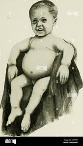 Image result for Craniotabes