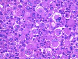 Bdepartment of pathology, memorial sloan kettering cancer center, new york,. Pathology Walker Auto Tweet Bot On Twitter Malignant Mesothelioma Pleural Fluid Conventional Cytology And Cell Block Study Pap He Calretinin And D2 40 Pathology Https T Co Xaulkhzyr7