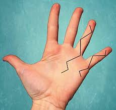 Dupuytren S Contracture Dupuytren S Contracture How To Stay Healthy Health Heal
