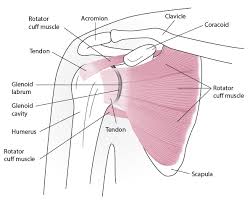 Bursitis often occurs when tendonitis and impingement syndrome cause inflammation of the bursa sacs that protect the shoulder. Rotator Cuff Injury Subacromial Bursitis Injuries And Poisoning Merck Manuals Consumer Version