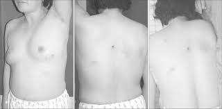 I start with the balls positioned about two inches apart, on either side of the spine at the level of my lower ribs. The Grouped Erythematous Vesicles On The Left Anterior Chest Lt T4 Download Scientific Diagram