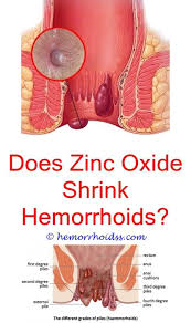 Pin On How To Get Rid Of External Hemorrhoids