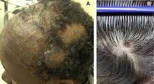 Sometimes, it might go through balding. Management Of Lupus Erythematosus Alopecia Ccid