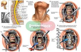 C5 And C6 Bulging Disc Surgery Spine Surgery C5 6 And C6 7 Anterior Cervical Discectomy With Spinal Spinal Fusion Cervical Spinal Stenosis Spine Surgery
