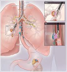 Image result for Lung Cancer