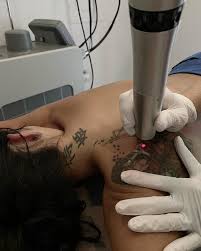 Tattoo removal in newport news is as simple as browsing through our list of tattoo removal providers and finding the right specialist in newport news. Numa Spa A Little Tattoo Removal Action Today At The Facebook