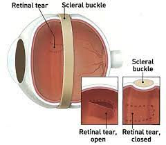 Jul 05, 2020 · detached or torn retina: Retinal Detachment Lexington Retinal Tears Louisville Retina Associates