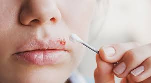 It is better to get a new toothbrush. How To Get Rid Of A Cold Sore Fast
