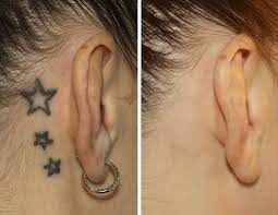 Getting your tattoo done by. Before After Tattoo Removal Lexington Ky Inkundu