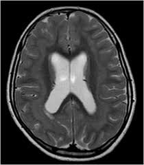 Clinical data and mri scans from 10 patients age 3 days to 27 years (mean age 4.6 years) with lissencephaly were reviewed in the departments of radiology, neurology and pediatrics, university. Band Heterotopia An Unusual Cause Of Seizures Irish Medical Journal