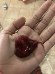 Miscarriage blood clots pictures 2 weeks. Miscarriage Or Bloodclot Babycenter