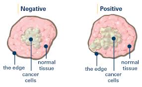 For example, an enlarged prostate gland can elevate the psa, but this does not definitely mean a man has cancer of the prostate. Surgical Margins Breastcancer Org