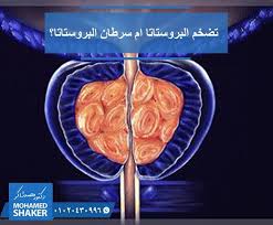 وبيا السرطان في عصر زيادة نسبة الإصابة بالسرطانات المختلفة أصبح لدينا خوف دفين من أي ورم يظهر في الجسم فمثلا الإصابة بتضخم البروستاتا توق prostate shaker