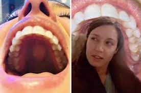 Your dentist can offer dental bonding according to an old wives' tale, telling a lie causes a bump on the tongue. A Small Percentage Of People Have A Bump On The Roof Of Their Mouths