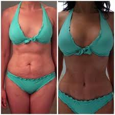 I Run I Run A Lot But I Knew That No Amount Of Diet And Exercise Was Ever Going To Get Rid Of The M Tummy Tuck Surgery Mommy Makeover Surgery