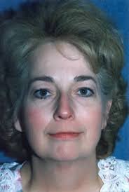 Facelift Surgery San Jose Mountain View CA