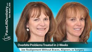 Underbite correction without surgery (epic new guide). How Can I Get Rid Of An Overbite Without Braces