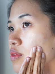 It's a rite of passage to adulthood, and with the passage of time (and the correct skincare products) most of us eventually conquer them—. Subclinical Acne What It Is And Why You Have It Cocokind