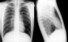Chronic Obstructive Lung Disease Copd Emphysema