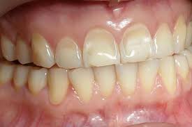 Dec 07, 2019 · dentists know that the enamel of teeth can regenerate. What Is Dental Erosion North Street Dental