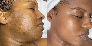 Urea, Gluconic acid and Hydroquinone