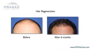 Finasteride (generic propecia®) is a prescription tablet that is used to treat hereditary hair loss. Finasteride Propecia Usage And Side Effects Ny Hair Loss