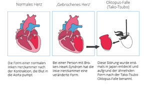 Broken Heart Syndrome Was Ist Das Uberhaupt I Herz Bewegt Informiert