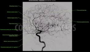 This vessel supplies blood to the front part of your brain, knows as your frontal lobe. Cerebral Angiography