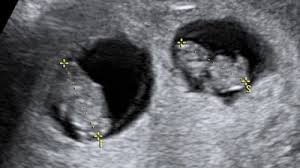 Entwicklung Zwillinge Im 3 Monat Ssw 9 Babywelten Ch