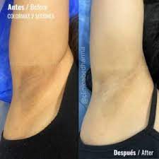Aclarar axilas con Colormax - Clínica Estética en Medellín