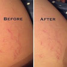 Bio Oil Scars Before And After Pictures Pin On Get Rid Of Stretch Marks