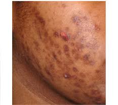 Image result for Postinflammatory Hypopigmentation