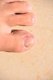 Staying One Step Ahead Of Toenail Fungus Harvard Health