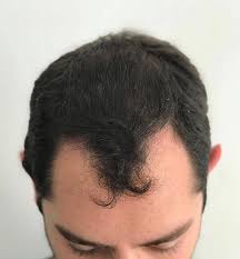They can also inform you about the effects you can expect from hair loss medications and other treatments, as well as the potential side effects. Getting To The Root Of Hair Loss In Young People Is Key To Treatment Ishrs