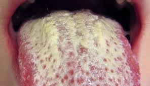 Image result for oral thrush symptoms roof of the mouth