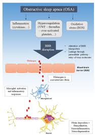 Jun 19, 2021 · durou pouco mais de um ano o casamento de ana maria braga com o empresário francês johnny lucet. Jcm Free Full Text Obstructive Sleep Apnea Hypercoagulability And The Blood Brain Barrier Html