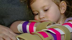 Firefighter father promotes bonfire safety after daughter falls into flames 