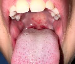Image result for Hand foot and mouth disease HFMD roof of mouth