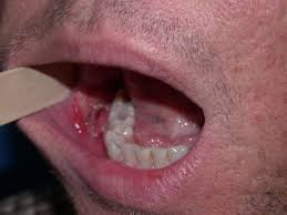 This is called oropharyngeal cancer. Oral Mouth Cancer Linked To Hpv Virus Hubpages