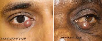 That's because skin cancer usually begins where you can see it. Ocular Oncology Eye Cancer And Eye Tumors Services