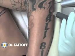 Introducing new picosure laser tattoo removal in los angeles. Laser Tattoo Removal On Arm Length Letters Tattoo Removal Los Angeles Dallas Houston Youtube