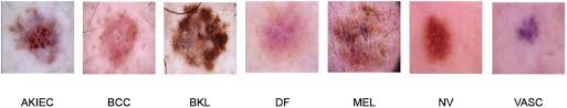 Although the percentage of cases in men is much lower than in women, male breast cancer accounts for a por. Soft Attention Improves Skin Cancer Classification Performance Medrxiv