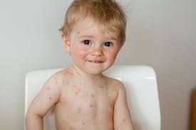 Ausschlag Bei Kindern Die Unterschiedlichen Ursachen Und Behandlungen