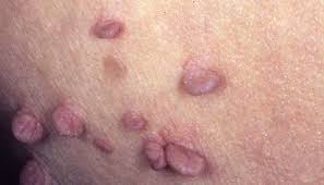 If the hemorrhoids are indeed thrombosed, then medical treatment will not help much. Anal Skin Tag Removal Recovery And Prevention