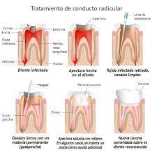 Endodoncia Clinica El Ratoncito Perez Root Canal Treatment Root Canal Dental Crowns