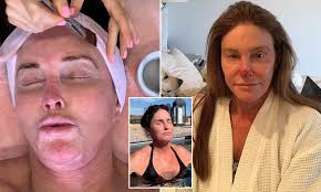 I am finally free to be myself! caitlyn jenner, 65, who as bruce won an olympic gold medal in the decathlon, has been in the public eye for decades. Caitlyn Jenner Reveals The Cancerous Spots She S Had Removed Due To Poor Sun Protection Daily Mail Online